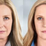 before and after - Sculptra treatment