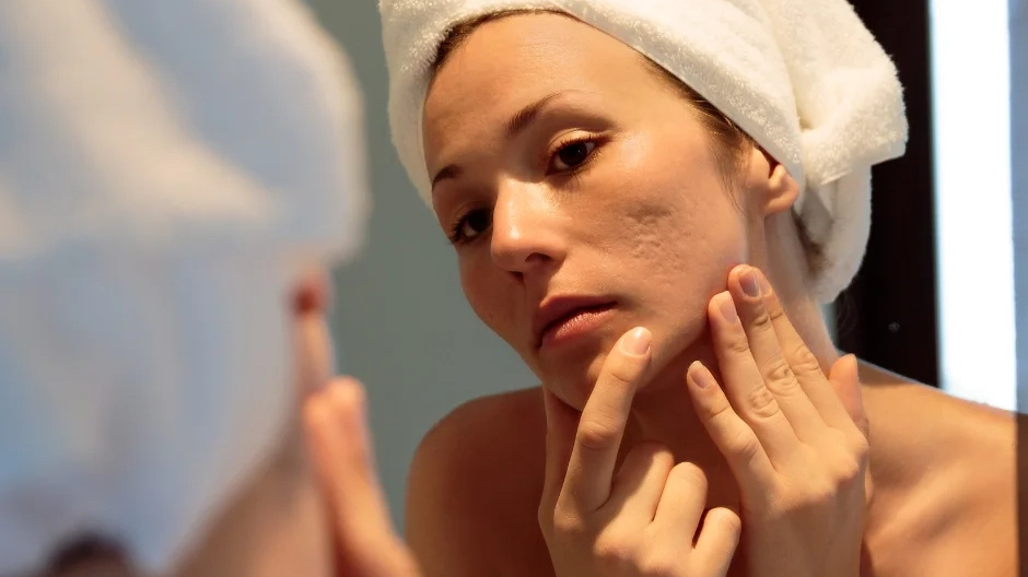acne skin concern causes