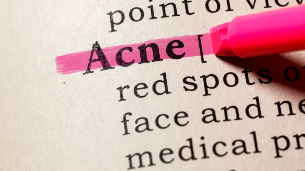 acne skin concern causes